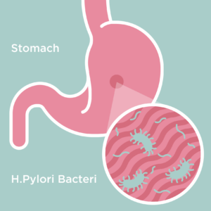 H.Pylori in the Stomach